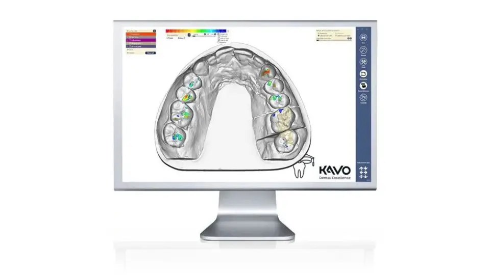 KaVo Virtuálny artikulátor – realistická simulácia oklúznych kontaktov
