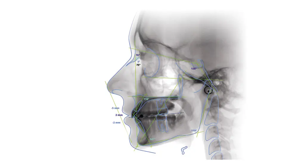 KaVo ProXam Cephalostat – presné cefalometrické snímanie pre ortodontickú diagnostiku