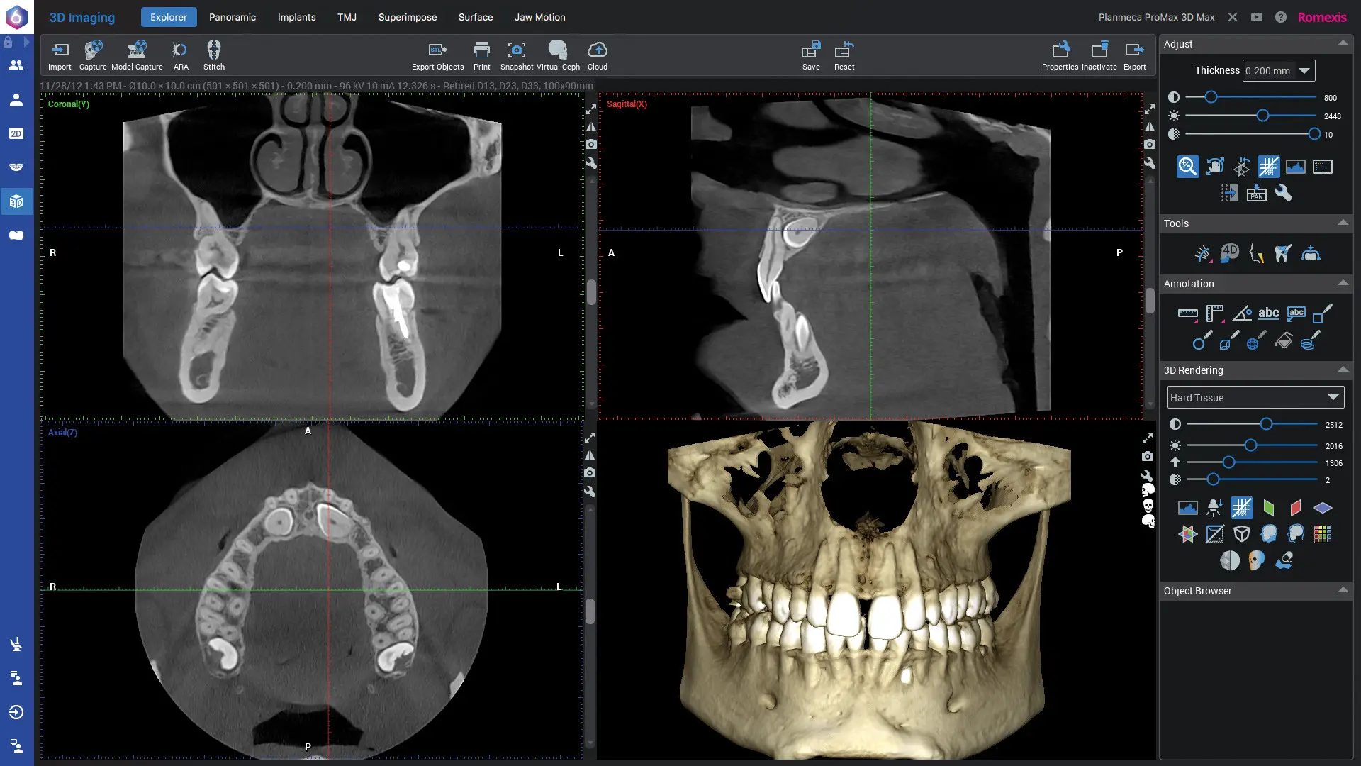 KaVo Romexis VR – pokročilé 3D plánovanie implantátov vo virtuálnej realite